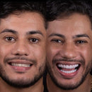 Facetas Odontológicas Removíveis